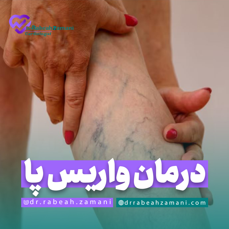 درمان واریس پا
