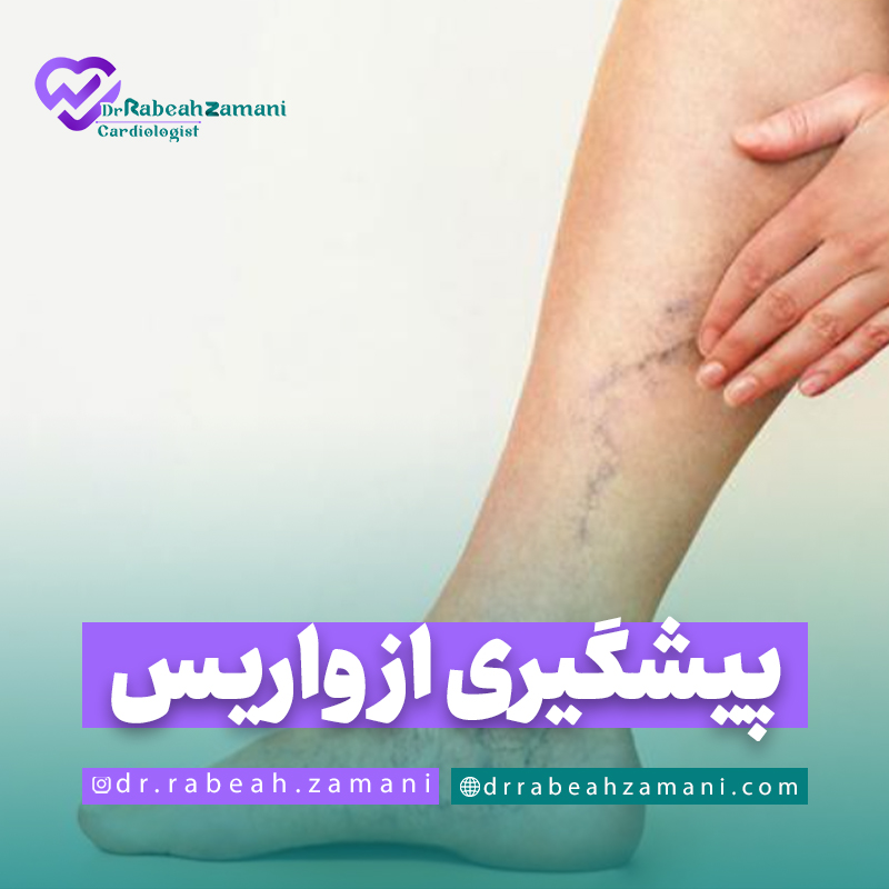 پیشگیری از واریس پا